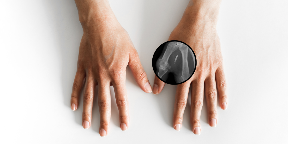 Hand with implantation of micro chip. X-Ray view close-up.